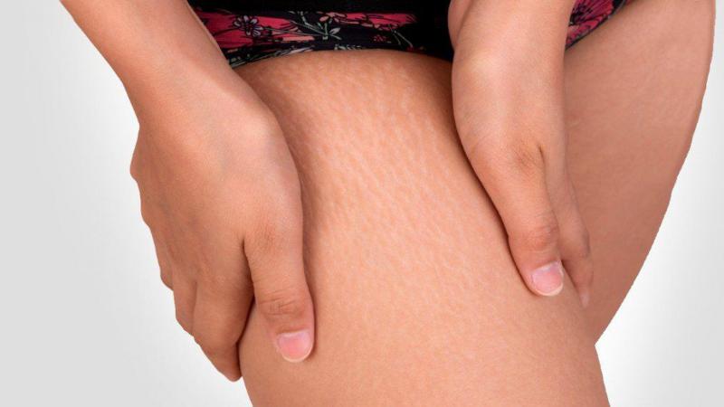 Как быстро убрать старые растяжки на теле