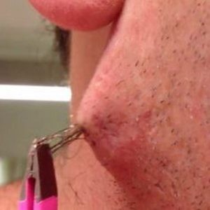 Средства и способы избавления от вросших волос