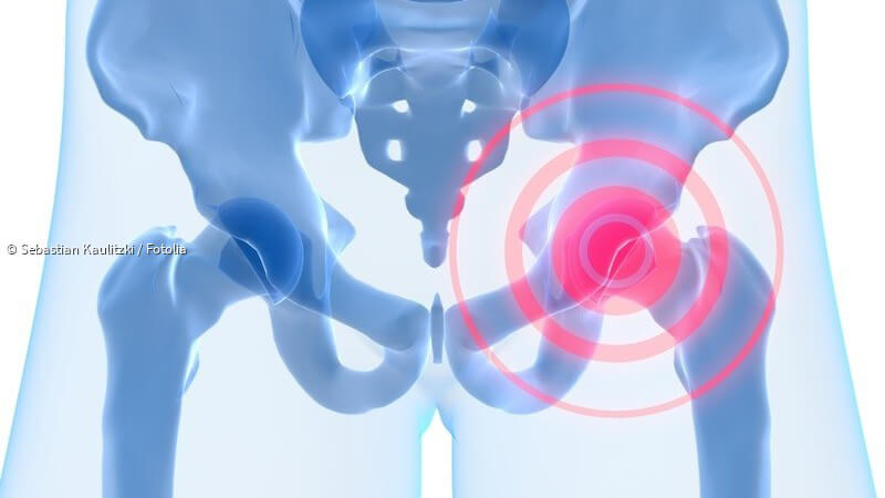 Как лечить эпифизеолиз головки бедренной кости