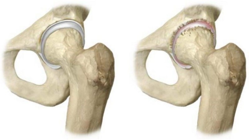Как лечить эпифизеолиз головки бедренной кости