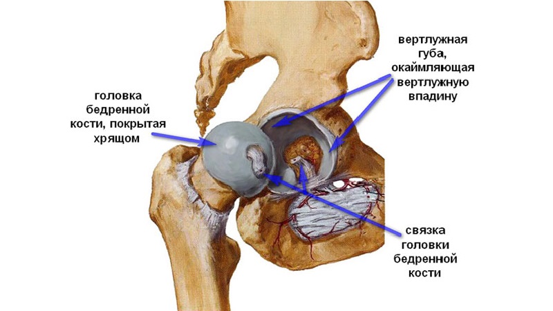 Как лечить эпифизеолиз головки бедренной кости