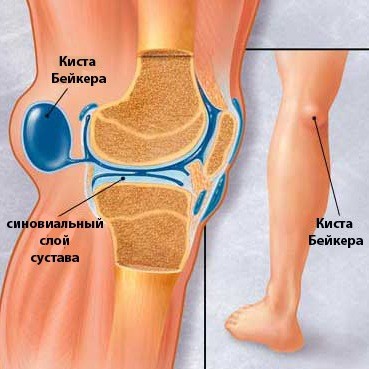 Как лечить кисту Бейкера под коленом