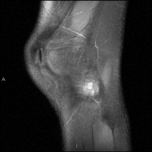 Как лечить кисту мениска