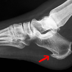 Как лечить шпоры на пятках народными средствами