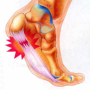 Как лечить шпоры на пятках народными средствами