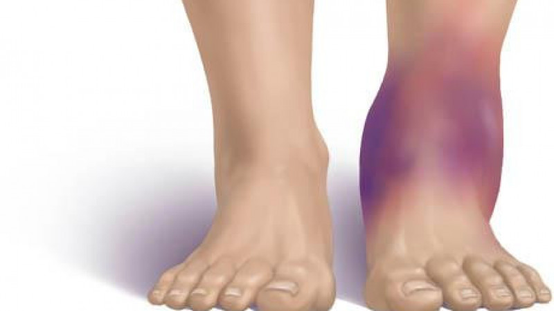 Как лечить ушиб голеностопного сустава