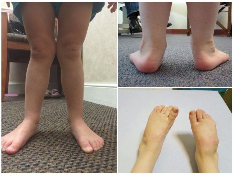 Как лечить варусную деформацию стоп