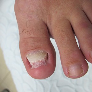 Восстановление ногтя после грибка