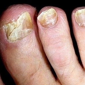 Какие есть средства для размягчения ногтей на ногах
