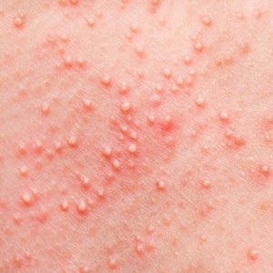 Как убрать раздражение после эпиляции в зоне бикини