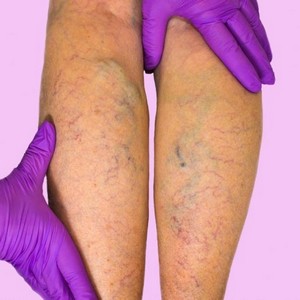 Витамины и другие способы укрепить стенки сосудов и вен