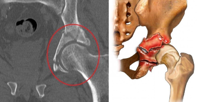 Как устроена вертлужная впадина тазовой кости и чем опасны её травмы