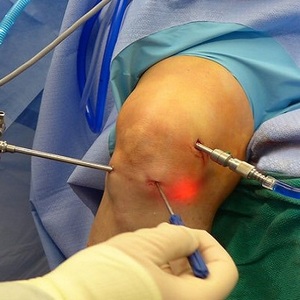 Как восстановить хрящевую ткань коленного сустава