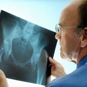 Как вправить тазобедренный сустав