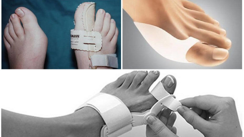 Как выбрать вальгусную шину для косточки