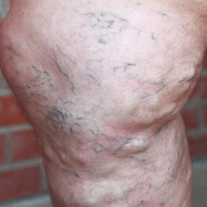 Противозачаточные таблетки при варикозном расширении вен