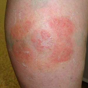 Товары от варикоза из Китая: мазь и пластырь - отзывы о применении