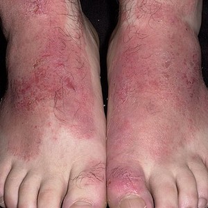 Как применять Климбазол от грибка ногтей