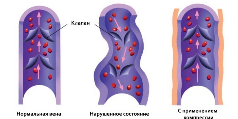 Можно ли носить компрессионное белье во время беременности и как выбрать подходящие чулки