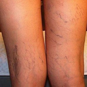 Как правильно принимать контрастный душ для ног при варикозе