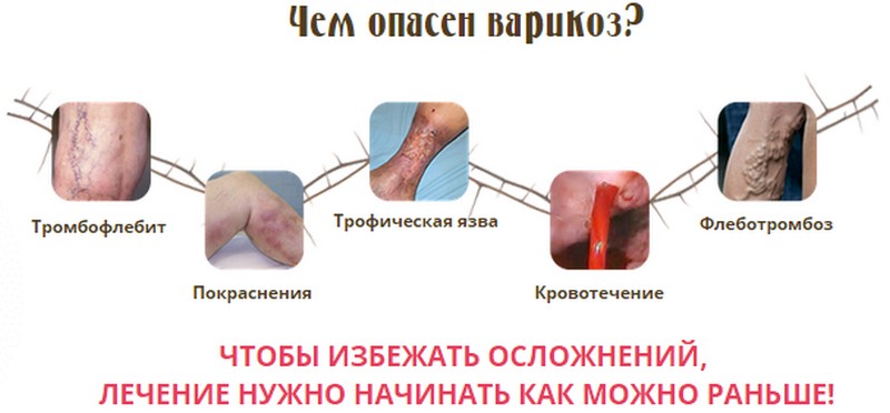 Какая мазь лучше всех помогает при варикозном расширении вен