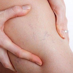 Какая мазь лучше всех помогает при варикозном расширении вен