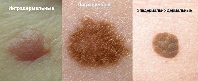 Стоит ли делать лазерную эпиляцию если есть родинки