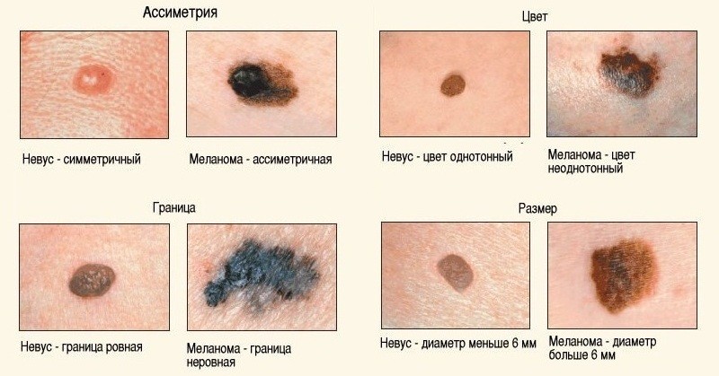 Стоит ли делать лазерную эпиляцию если есть родинки