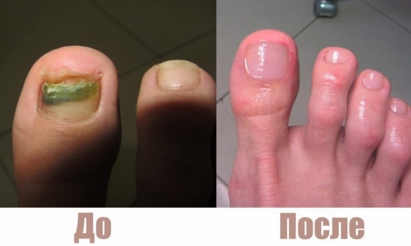 Как проводится лазерное лечение грибка ногтей