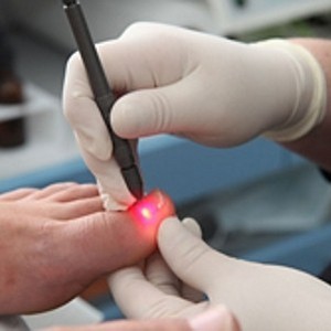 Как проводится лазерное лечение грибка ногтей