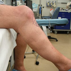 Виды заболеваний коленных суставов