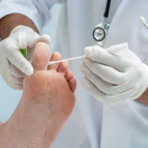 Как лечится дисгидротическая форма грибка стопы