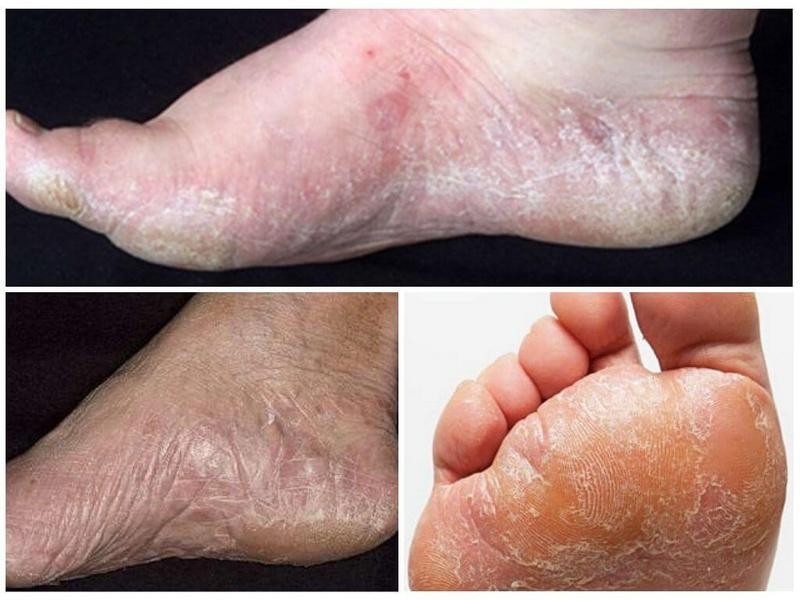 Как лечится дисгидротическая форма грибка стопы