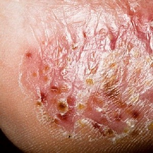 Как лечится дисгидротическая форма грибка стопы