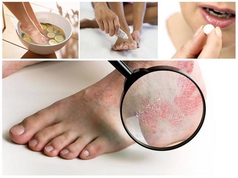 Как лечится дисгидротическая форма грибка стопы