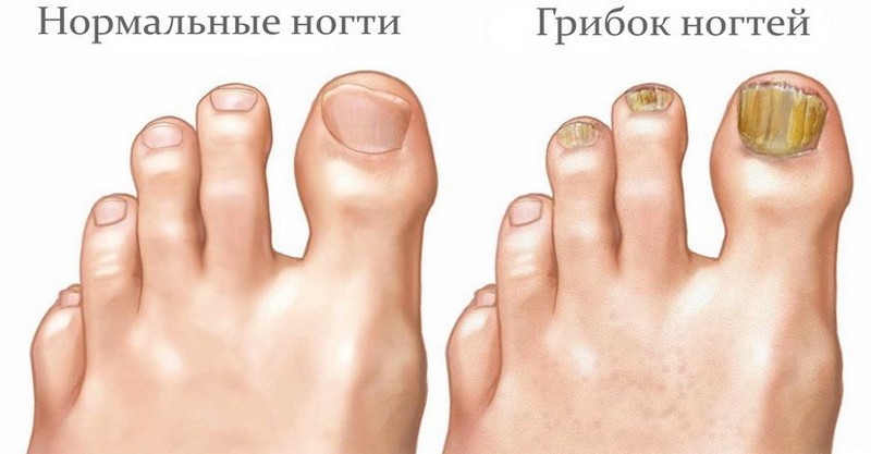 Как лечить грибок ногтей с помощью АСД 3