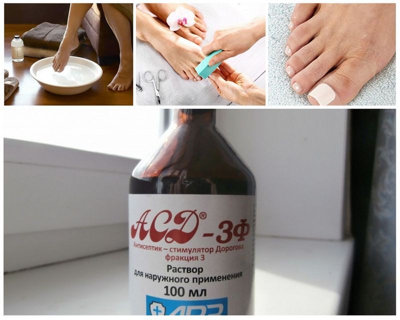 Как лечить грибок ногтей с помощью АСД 3