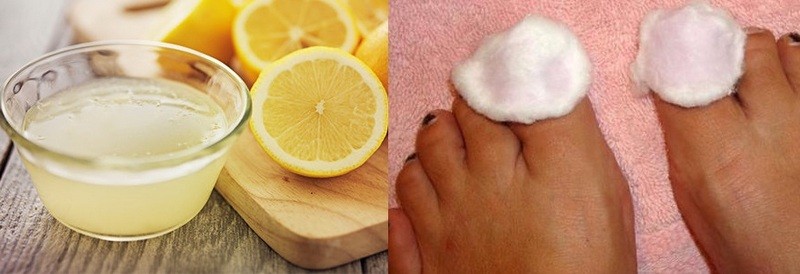 Лимон против грибка ногтей на ногах