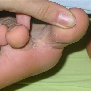 Методы лечения грибка ногтей на ногах