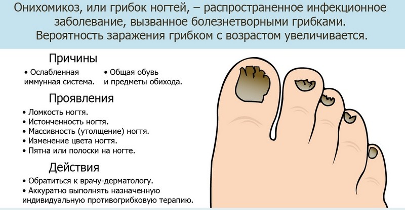 Методы лечения грибка ногтей на ногах