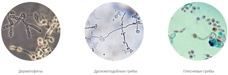 Методы лечения грибка ногтей на ногах