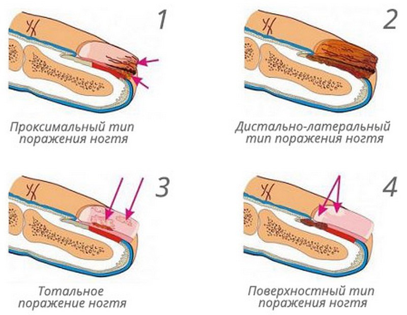 Методы лечения грибка ногтей на ногах