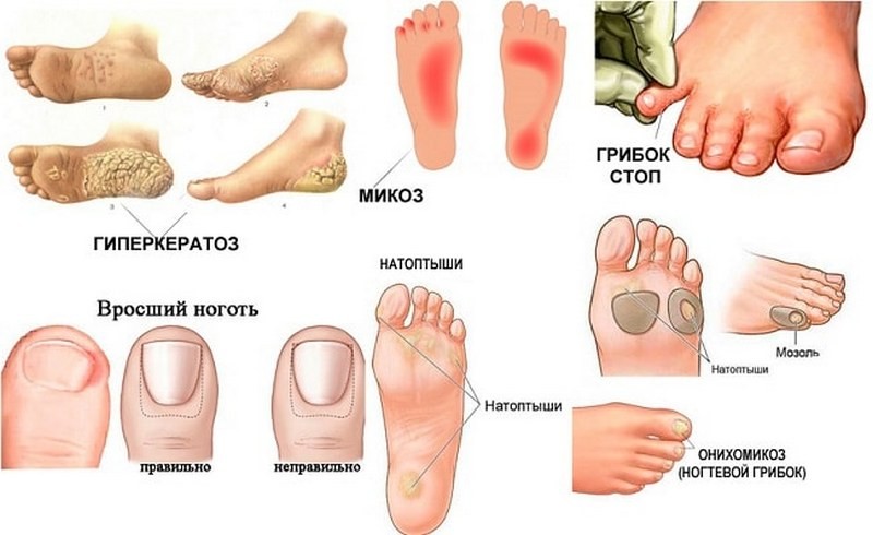 Как лечится грибок ногтей на ногах у беременных женщин