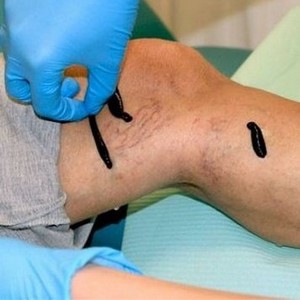 Как лечится варикозное расширение вен пиявками