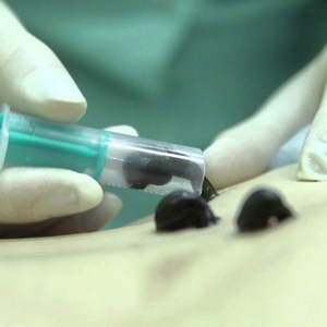 Как лечится варикозное расширение вен пиявками