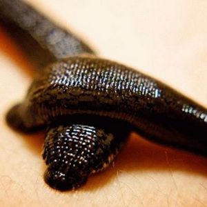 Как лечится варикозное расширение вен пиявками