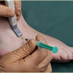 Как лечить синовит голеностопного сустава