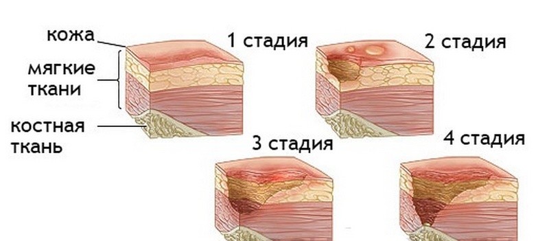 Что такое трофические язвы и как их лечить