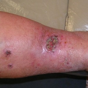 Что такое трофические язвы и как их лечить