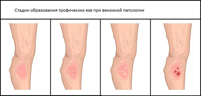Что такое трофические язвы и как их лечить